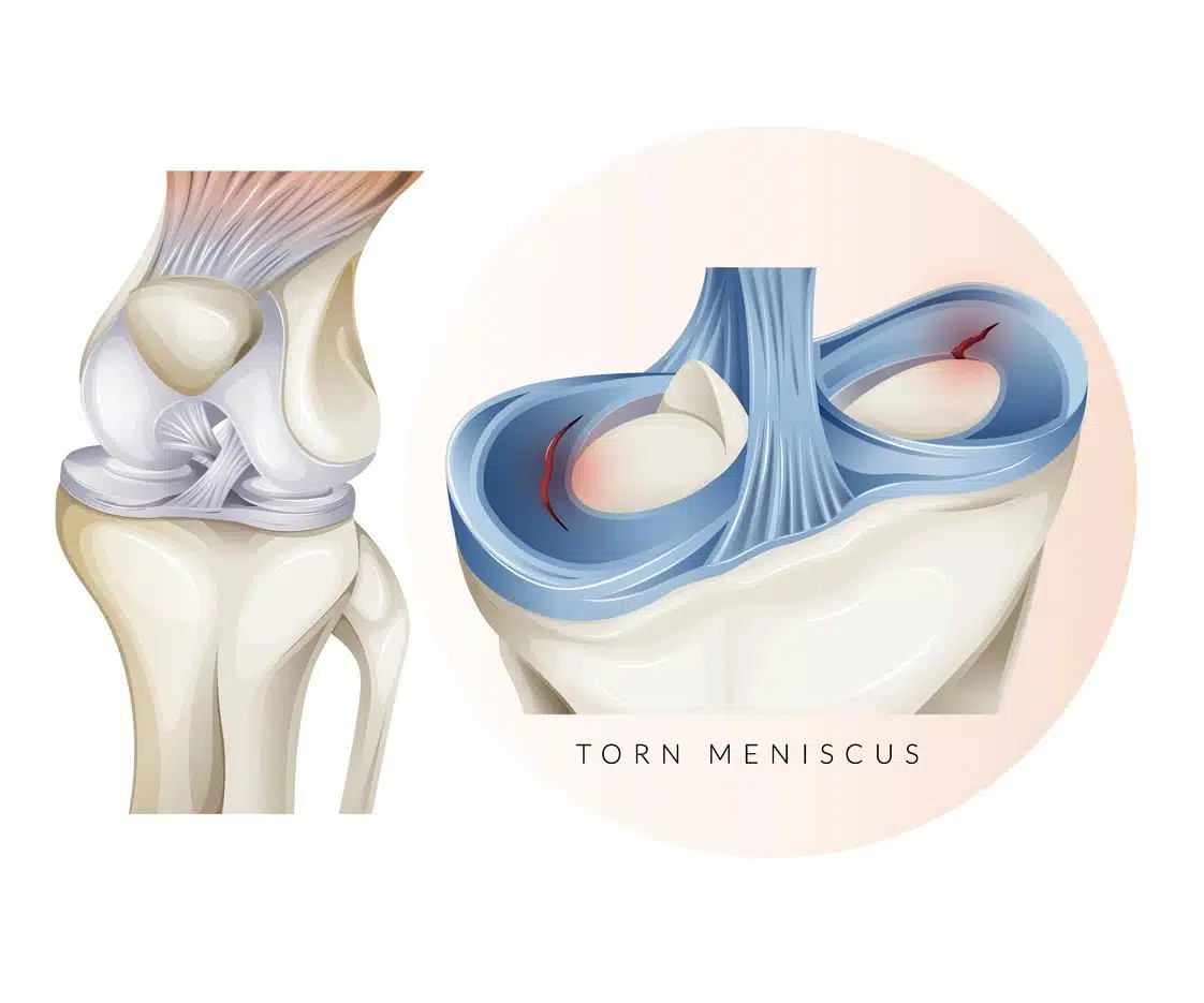 Knee Cartilage Injury Torn Meniscus Stock Illustration